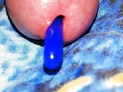 inserting silicone into the urethra